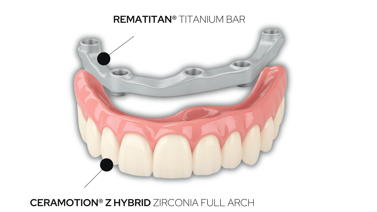 Why Titanium Bar reinforcement is important for full arch prosthesis?